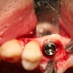 Le perimplantiti: sfida del futuro nella terapia implantoprotesica
