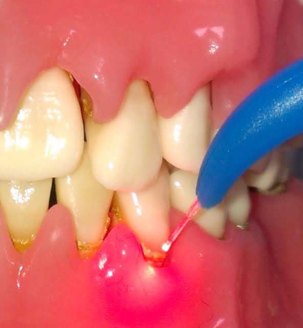 The use of diffuse laser photonic energy and indocyanine green photosensitiser as an adjunct to periodontal therapy.