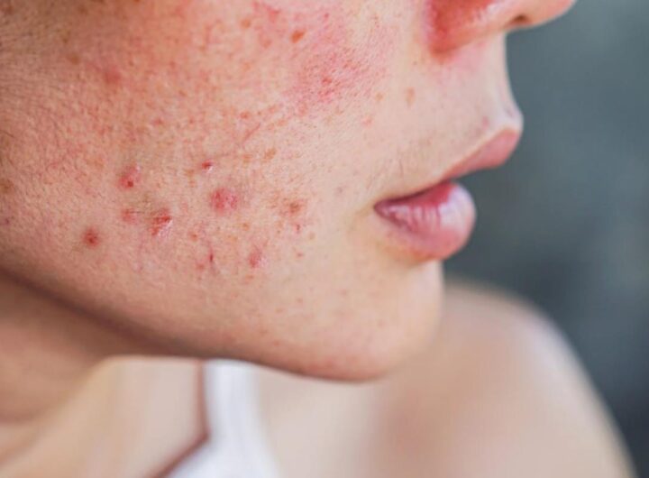 Addio acne